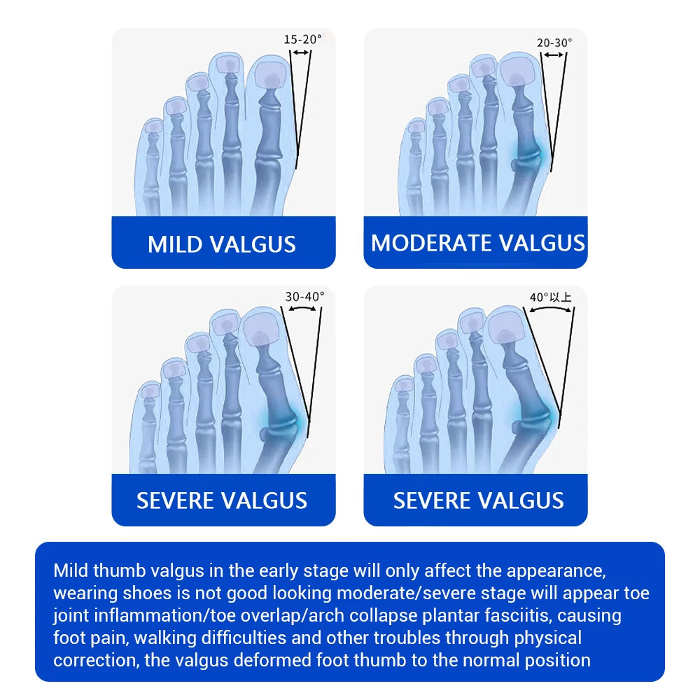 Moajaza Adjustable Bunion Corrector With Toe Straightener Brace